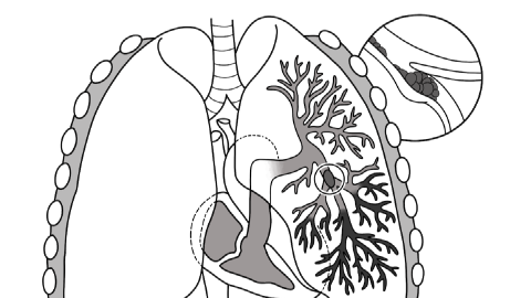 Featured Image for Wells' Criteria for Pulmonary Embolism